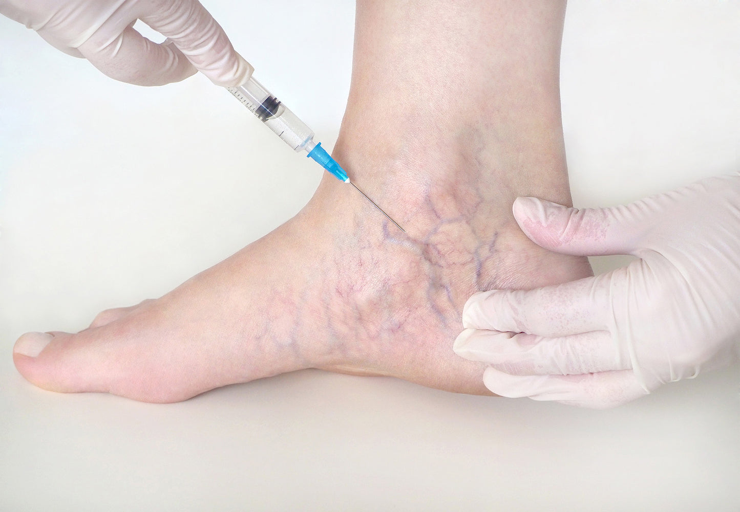 Sclerotherapy- Spider Vein Removal